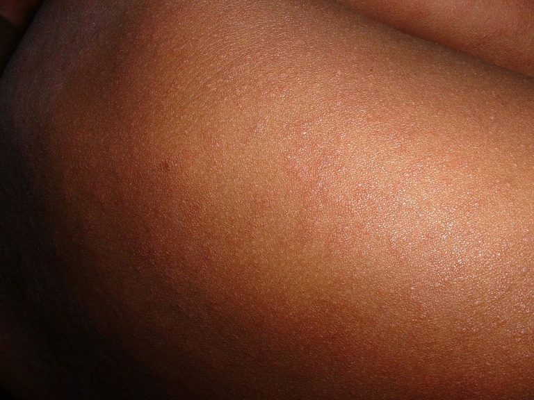 U.S. measles outbreak spreads to Idaho, Virginia