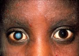 Cataract, Main Cause Of Infant Blindness - Opthalmologist