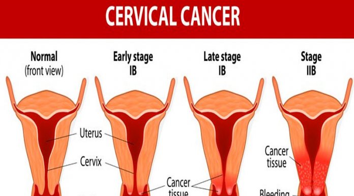 Cervical Cancer: How Govt Gambles with Women’s Rights