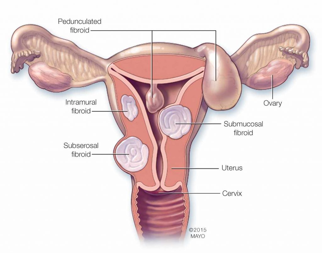 Tackling Fibroid Endometriosis Through Laparoscopy