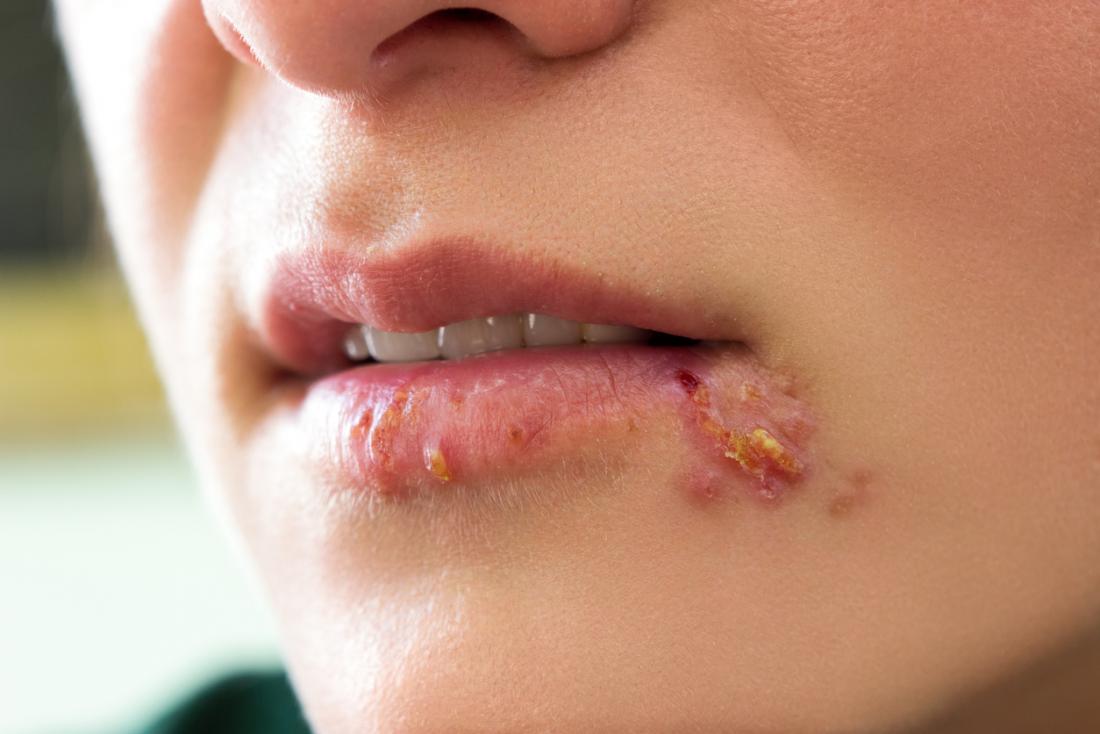 Half A Billion Globally Living With Herpes – WHO