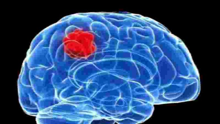 Israeli Scientists Discover Way To Stop Spread Of Brain Cancer