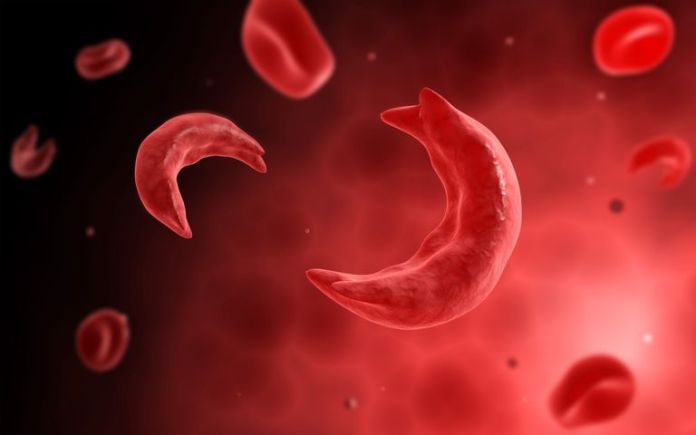 UK Announces ‘Life Changing’ Treatment For Sickle Cell