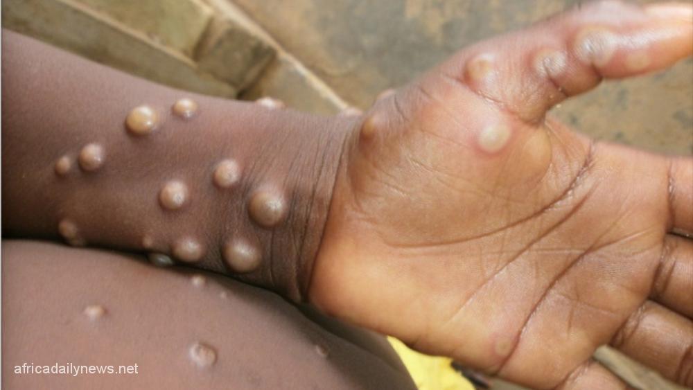Monkeypox Outbreak Nigeria Intensifies Surveillance