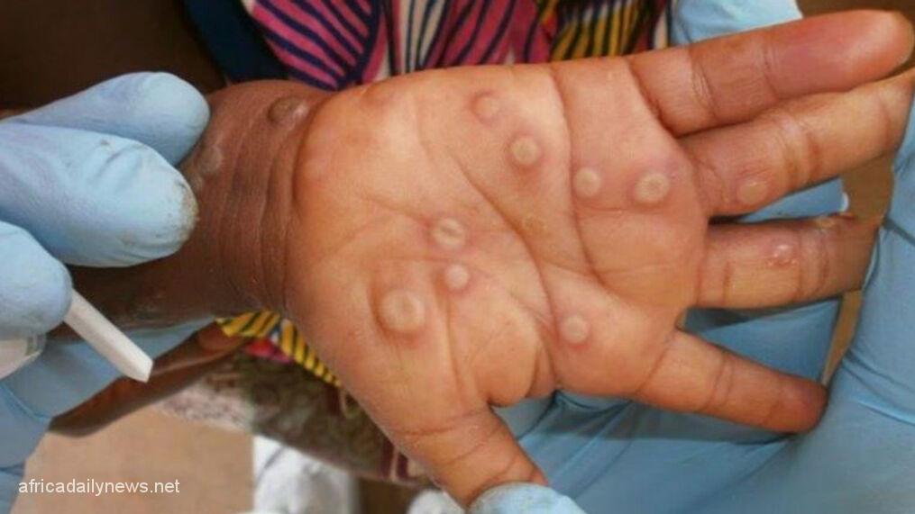 Over 700 Monkeypox Cases Recorded Globally, 21 In US - CDC